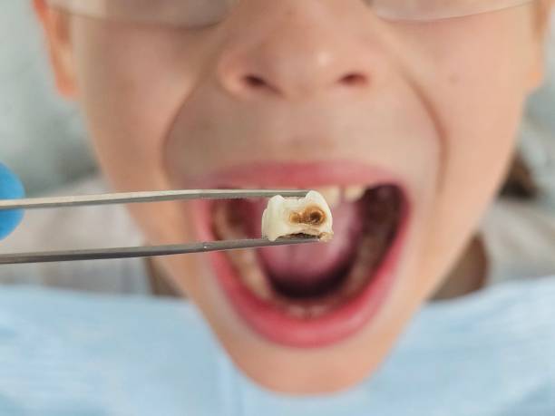 Best Emergency Wisdom Teeth Removal in Madras, OR